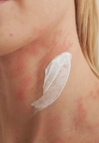 Moisturizing cream applied to a neck area with reddish skin irritation. The cream is white, smooth, and has a creamy texture.