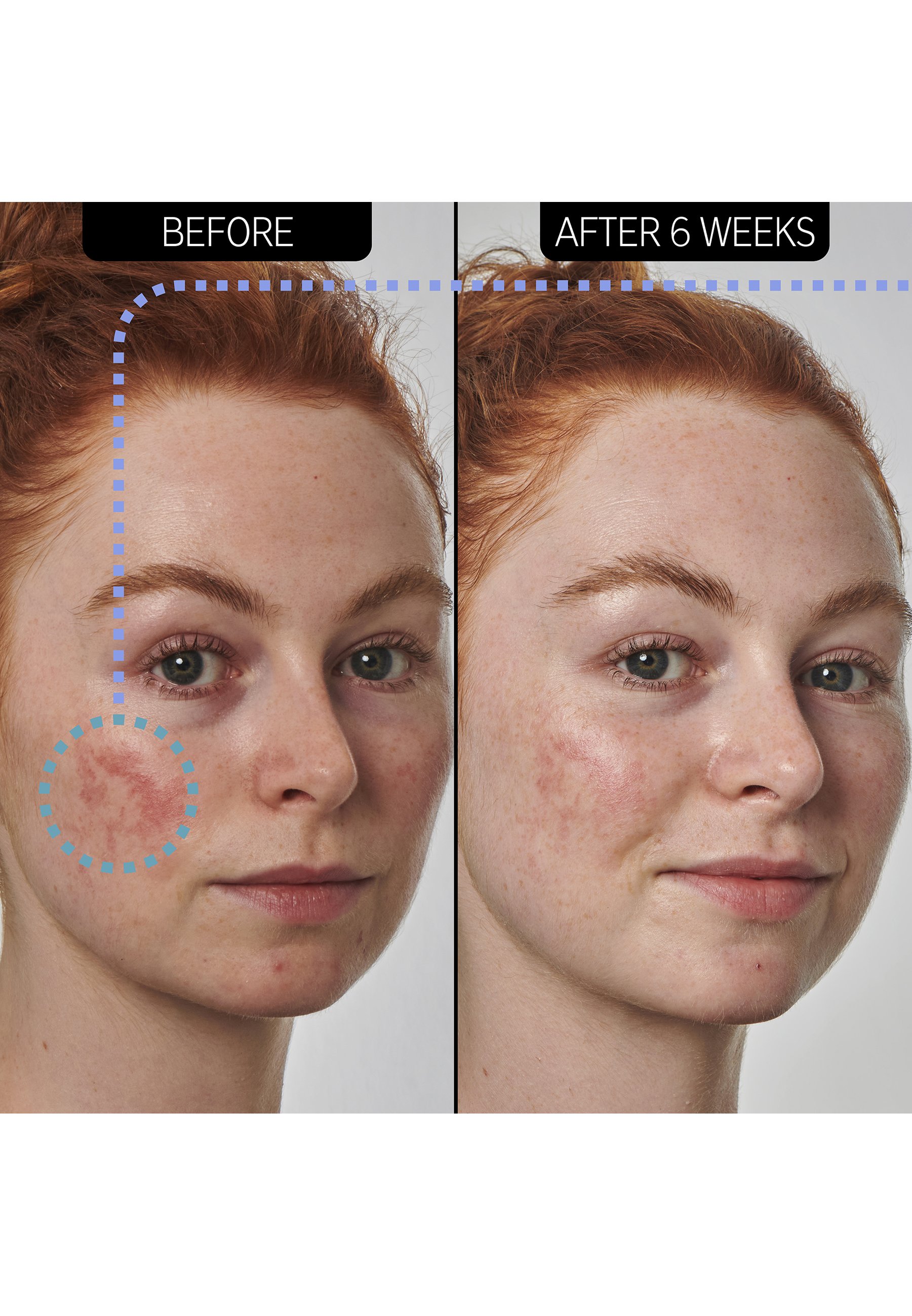 Serum Do Twarzy Skindivision 10% Azelaic Acid Serum In Cream