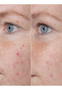 BABOR HYALURONIC ACID AMPOULE - Serum