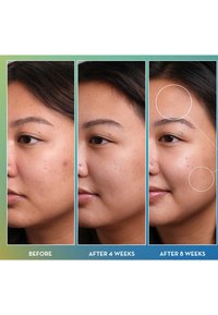 Trzy profile boczne twarzy pokazujące poprawę stanu skóry w czasie, z widocznymi pryszczami przed, i czystszą skórą po 4 i 8 tygodniach.