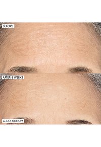 Dwa obrazy przedstawiające czoło: górny oznaczony jako "Przed" z delikatnymi zmarszczkami, a dolny oznaczony jako "Po 8 tygodniach" z poprawioną strukturą i mniejszą ilością zmarszczek.