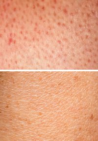 Nahaufnahme der Hautstruktur: Oben sind kleine rote Beulen sichtbar, während der untere Teil glatt mit feinen Linien und leichten Pigmentvariationen ist.