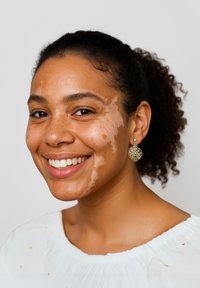 Kvinna med lockigt, mörkt hår och en ljusbeige hudton med tydliga ljusare fläckar, iförd en vit topp och dekorativa guldörhängen.