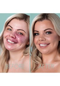 Before and after comparison of a woman's face, showing significant improvement in skin tone and texture. The left has redness and unevenness, while the right appears smooth and even-toned.