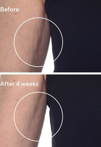 Jämförelse av hudens struktur på överarmen, som visar mer definierade linjer och en jämnare yta efter 4 veckors behandling.