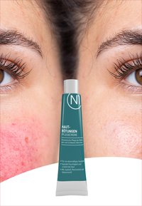 Tube mit Hautcreme, türkises Etikett und silberner Kappe. Nahaufnahme der Haut mit Rötungen und unterschiedlicher Textur auf beiden Seiten.