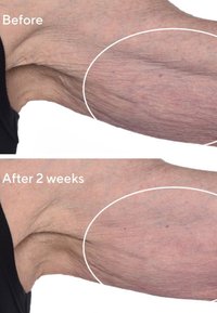 Före- och efterjämförelse av en underarm som visar skillnader i hudens textur; synliga rynkor och lös hud är närvarande.