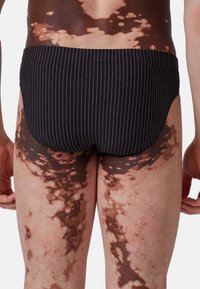 Person trägt schwarze gestreifte Slips und zeigt Haut mit großen unregelmäßigen Flecken von Vitiligo auf dem Rücken, den Hüften und den oberen Oberschenkeln.