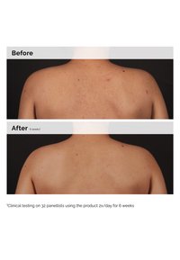 Imágenes de antes y después de la piel de la espalda, mostrando diferentes niveles de imperfecciones y textura de la piel durante un período de 6 semanas.