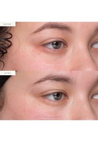 Comparaison avant-après montrant la zone des yeux d'une personne. En haut : un gonflement et une ombre visibles sous l'œil. En bas : une peau plus lisse et plus ferme.