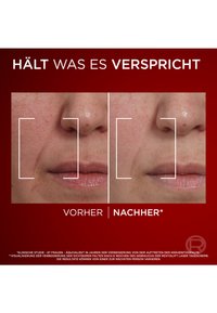 Före-och-efter-jämförelse av huden runt munnen; vänster sida visar djupare linjer, höger sida har slätare hud, båda med naturliga nyanser och texturer.