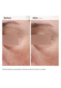 Two side-by-side images showing skin under the eyes. Left: uneven texture, fine lines, and blemishes. Right: smoother, clearer skin after 12 weeks.
