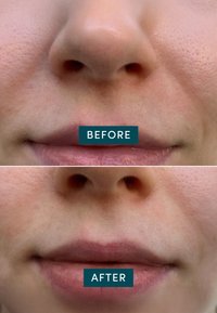 Apricot Beauty MOUTH PATCHES WITH HYALURON - Maschera viso - 0