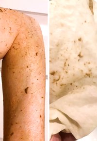 Nahaufnahme eines hellbraunen, exfolierten Arms mit dunklen Flecken und einem zerknitterten, hellen, strukturierten Stoff mit hellbraunen Flecken.