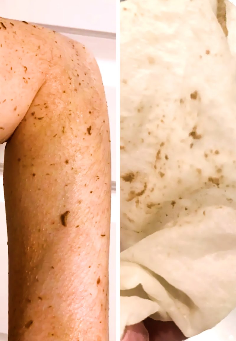 Nahaufnahme eines hellbraunen, exfolierten Arms mit dunklen Flecken und einem zerknitterten, hellen, strukturierten Stoff mit hellbraunen Flecken.