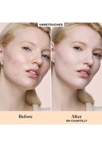 Immagini prima e dopo di un volto con pelle chiara e capelli biondi, che mostrano acne a sinistra e pelle più chiara a destra, su uno sfondo neutro.