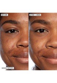 Før-efter sammenligning af et ansigt, der viser acne til venstre, klarere hud efter en uge til højre. Begge billeder har tekstetiketter.