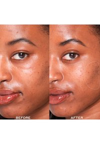 Porównanie twarzy z boku, przed i po zabiegu. Lewa strona pokazuje niedoskonałości; prawa strona wygląda na czystszą i gładszą.