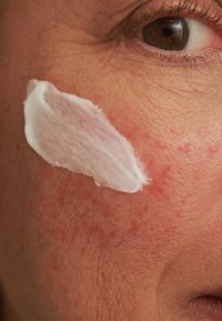 White cream applied to textured skin with visible redness, highlighting fine lines and a few small hairs. Close-up of facial area.