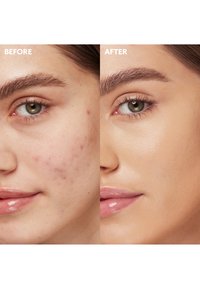 Før: hud med synlig acne, rødme og ujævn tekstur. Efter: glat, ensartet hudtone med en mat finish og sund glød.