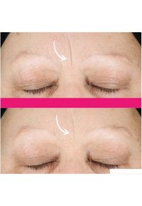 Panna före och efter behandling; överdelen visar en framträdande rynka, medan den nedre bilden visar minskad synlighet av rynkan med en jämnare hudstruktur.