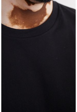 Gros plan du cou et du menton d’une personne avec une décoloration de la peau due au vitiligo, portant un t-shirt noir à col rond et une barbe partiellement visible.