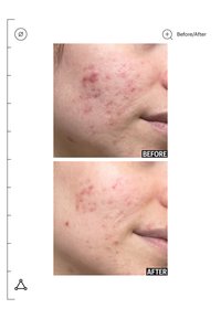 Close-up of a person's cheek showing reduced acne and redness in a side-by-side before and after comparison.
