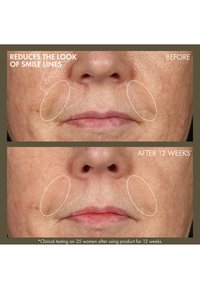 Avant et après : images de la peau du visage montrant une réduction des rides d'expression. La peau semble plus lisse et plus ferme après 12 semaines d'utilisation.