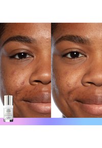 Før og efter billeder af hud, der viser reducerede blemisser. Viser en hvid flaske mærket "Good Genes." Hudtonen er medium med antydninger af tekstur.