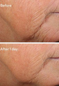 Images en gros plan avant et après montrant la texture de la peau, avec des rides réduites et un aspect plus lisse après un jour de traitement.