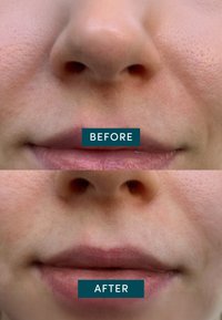 Close-up van lippen en neus waarbij de vollere, soepelere lippen in de "na"-foto worden vergeleken met de dunnere, droge lippen in de "voor"-foto.