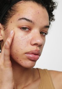 Lockar i ett hårband, närbild på hud med akne, släta läppar och en lätt glans. Hudtonen är ljus till medelhav med röda fläckar.