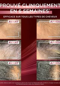 Images avant et après montrant des zones du cuir chevelu. Les images mettent en évidence des densités et textures de cheveux variées, étiquetées "Avant" et "Après."