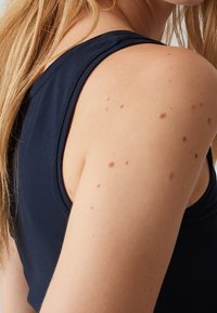 Gros plan sur une épaule et un haut du bras nus avec plusieurs grains de beauté marron, portant un haut bleu foncé sans manches et des cheveux blonds tombant dans le dos.