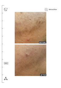 Gros plan de la peau montrant une rougeur réduite et moins d'imperfections dans la section « après » par rapport à la section « avant ».