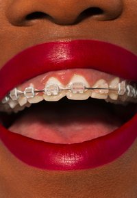 Braces with clear brackets on teeth, framed by bold red lipstick. Close-up view emphasizes the shiny texture of the lips and dental hardware.