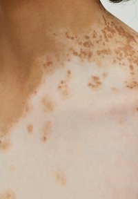 Nahaufnahme von Haut, die hellbraune marmorierte Muster vor einem hellen Hintergrund zeigt, was Variationen in der Pigmentierung anzeigt. Glatte Textur.