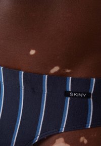 Primo piano di pelle scura con macchie di vitiligo che indossa biancheria intima a strisce blu etichettata "SKINY."