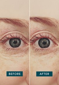 Zbliżenie porównawcze dwóch ludzkich oczu: lewe pokazuje widoczne zmarszczki i ciemne kręgi, prawe wydaje się gładsze i o bardziej jednolitym odcieniu. Etykiety tekstowe "Przed" i "Po".