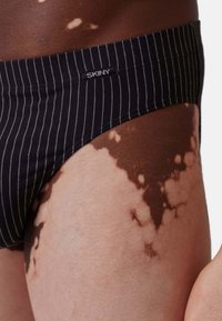 Nahaufnahme einer Person mit Vitiligo, die schwarze gestreifte SKINY-Unterwäsche trägt, die den Hautkontrast und die Stoffstruktur an der Hüfte zeigt.