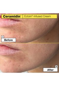 Crème Ceramidin Infusée d'Ectoin : comparaison côte à côte de la peau, présentant une surface sèche et texturée "Avant" et un aspect plus lisse et uniforme "Après".