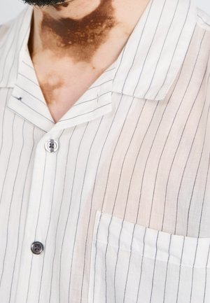 Gros plan d'une personne portant une chemise blanche boutonnée avec de fines rayures verticales noires et une tache de naissance visible sur le cou.