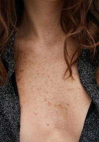 Gros plan sur la poitrine et le cou d'une personne tachetée de rousseur avec des cheveux bruns ondulés, portant un vêtement noir et blanc à motifs.