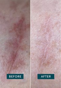 Huidvergelijking die twee secties toont: de linkerkant heeft rode vlekken en een ongelijkmatige textuur, terwijl de rechterkant er gladder uitziet met een lichtere pigmentatie.