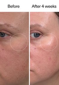 Close-up van de wang van een persoon met verminderde rimpels en een gladdere huidtextuur na 4 weken behandeling.