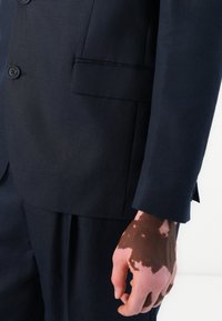 Hand mit Vitiligo neben einer Tasche eines marineblauen Anzugs und passenden Hosen vor einem schlichten weißen Hintergrund.