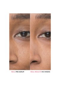 Gros plan comparatif de la zone autour de l'œil d'une personne montrant une texture de peau réduite et un teint plus lisse après 6 semaines d'utilisation du sérum.