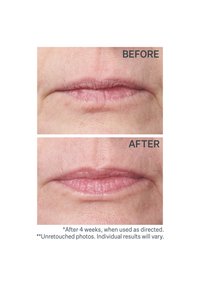 Bereich um die Lippen vor und nach der Behandlung. Oben sind trockene, feine Linien zu sehen; unten erscheint die Lippenpartie glatter, mit volleren, hydratisierteren Lippen.