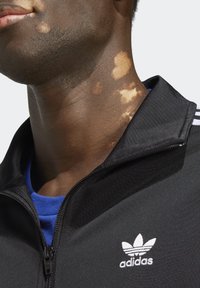 Närbild av en persons hals med vitiligo-fläckar, iklädd en svart Adidas-jacka och en blå skjorta under.