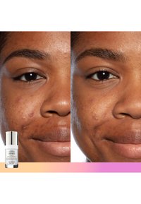 Comparaison avant et après le traitement de la peau montrant un teint lisse avec une réduction de l'acné. Flacon en verre transparent du produit en bas à gauche.